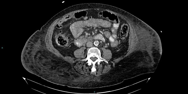 File:Breast cancer pelvic bony metastases (Radiopaedia 84470-99824 Axial bone window 8).jpg