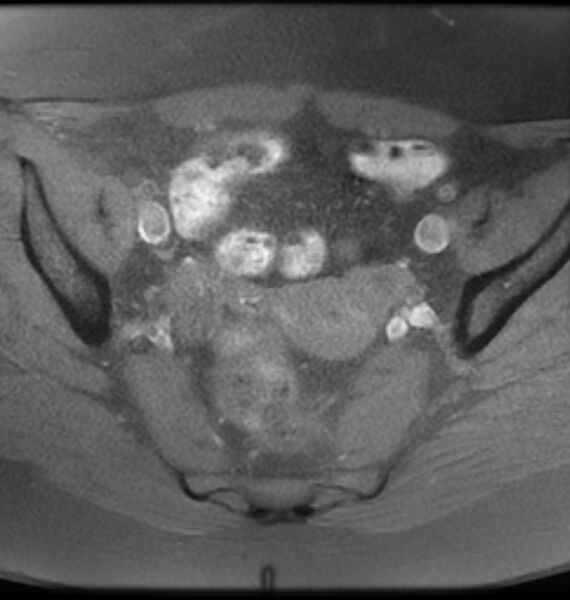 File:Broad ligament leiomyoma (Radiopaedia 81634-95516 Axial T1 fat sat 10).jpg