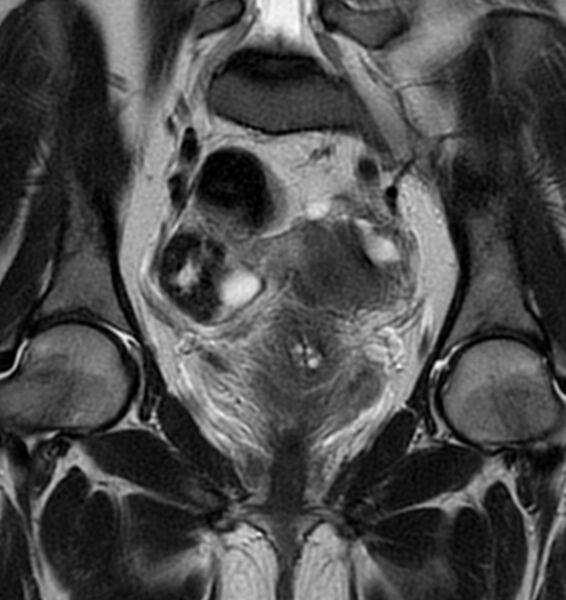 File:Broad ligament leiomyoma (Radiopaedia 81634-95516 Coronal T2 12).jpg