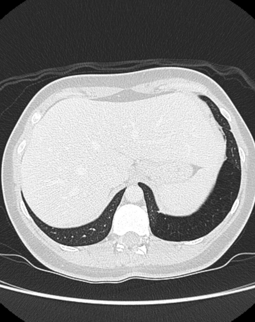 Bronchial atresia (Radiopaedia 50007-55297 Axial lung window 101).jpg