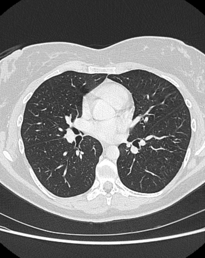 Bronchial atresia (Radiopaedia 50007-55297 Axial lung window 54).jpg