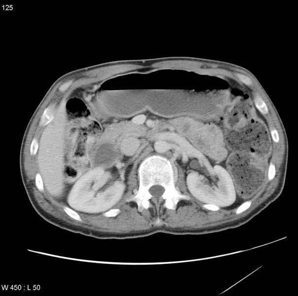 File:Bronchogenic carcinoma (Radiopaedia 8857-9645 A 22).jpg
