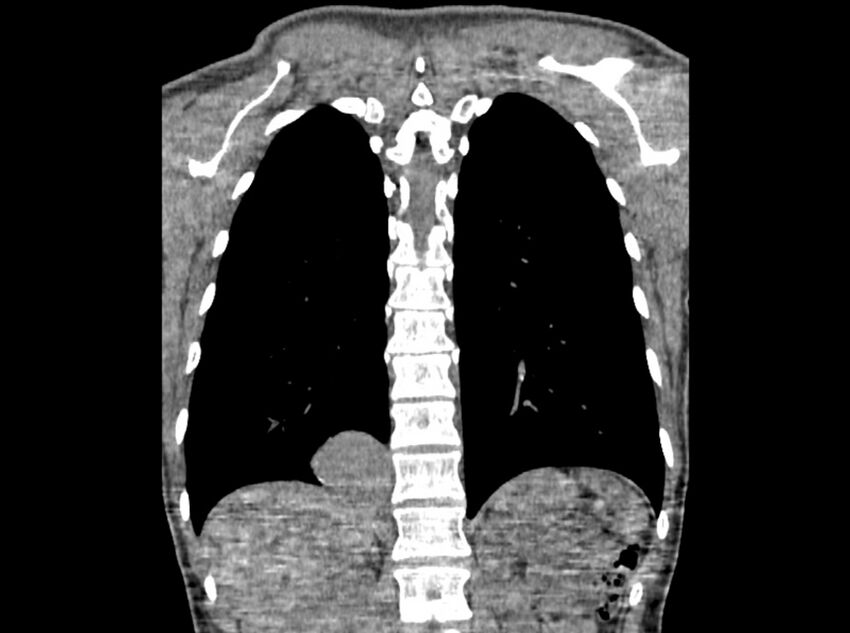 Bronchogenic cyst (Radiopaedia 80273-93615 D 94).jpg