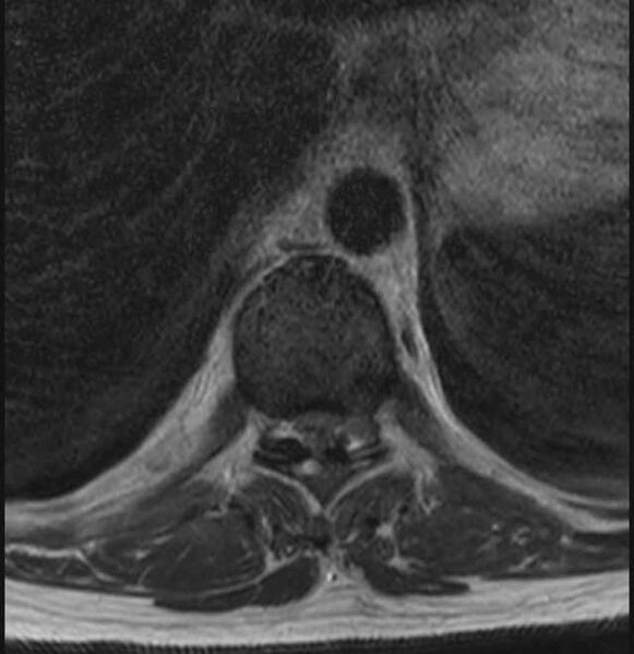 File:Brown tumors compressing the spinal cord (Radiopaedia 68442-78030 A 13).jpg