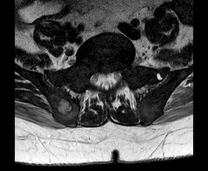 File:Brown tumors compressing the spinal cord (Radiopaedia 68442-78030 Axial T2 - lumbar 13).jpg