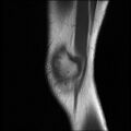Bucket handle tear - lateral meniscus (Radiopaedia 72124-82634 Sagittal T1 16).jpg