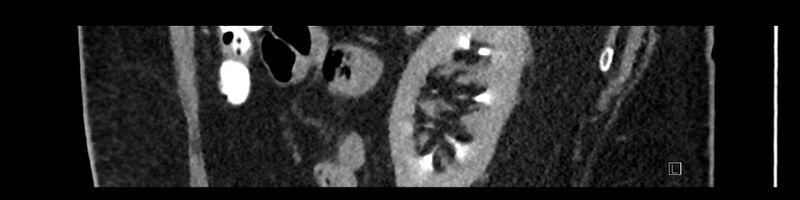 File:Buried bumper syndrome - gastrostomy tube (Radiopaedia 63843-72575 Sagittal Inject 32).jpg