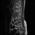 Burst fracture - lumbar spine (Radiopaedia 72877-83541 Sagittal T1 2).jpg