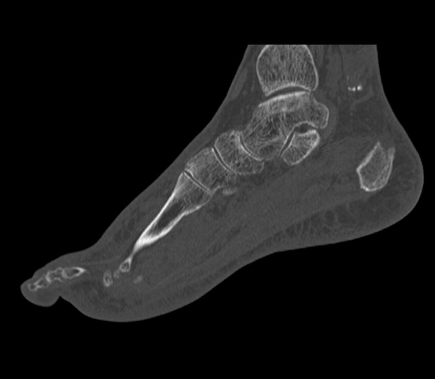 Calcaneal tuberosity avulsion fracture (Radiopaedia 22649-22668 Sagittal bone window 30).jpg