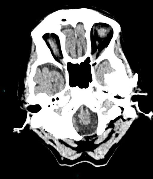File:Calcified cerebral emboli from left ventricular thrombus (Radiopaedia 84420-99758 Axial non-contrast 78).jpg