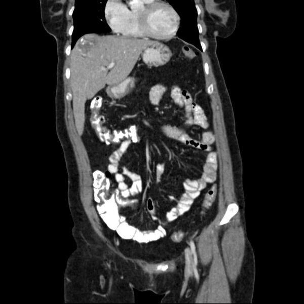 File:Calcified hydatid cyst of the liver (Radiopaedia 21212-21112 D 6).jpg