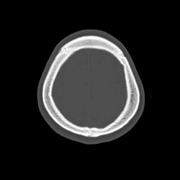File:Calvarial osteoma (Radiopaedia 36520-38079 Axial bone window 93).jpg