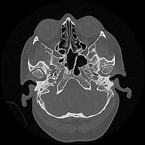 File:Canal up mastoidectomy (Radiopaedia 78108-90638 Axial bone window 41).jpg