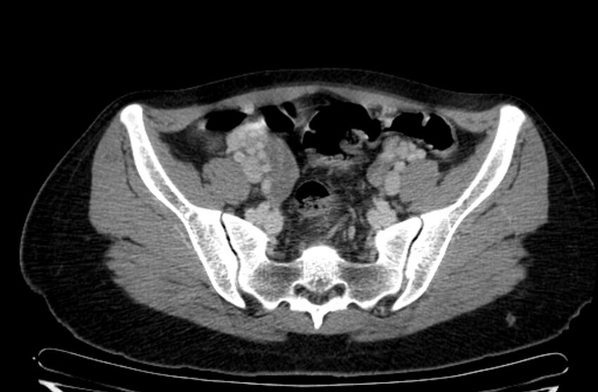 Cannonball metastases - uterine choriocarcinoma (Radiopaedia 70137-80174 A 7).jpg