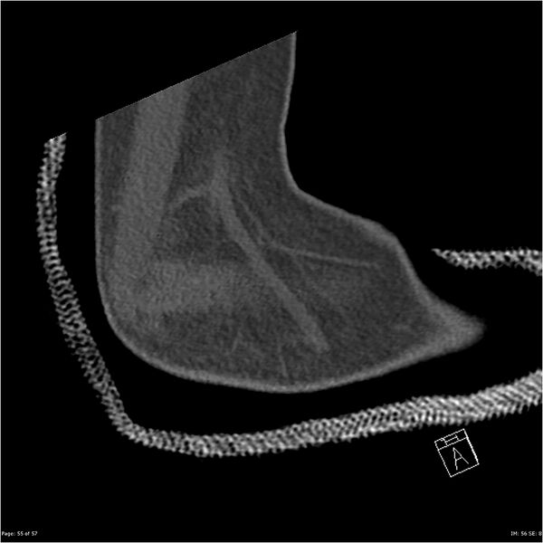 File:Capitellum fracture (Radiopaedia 23352-23426 Sagittal bone window 55).jpg