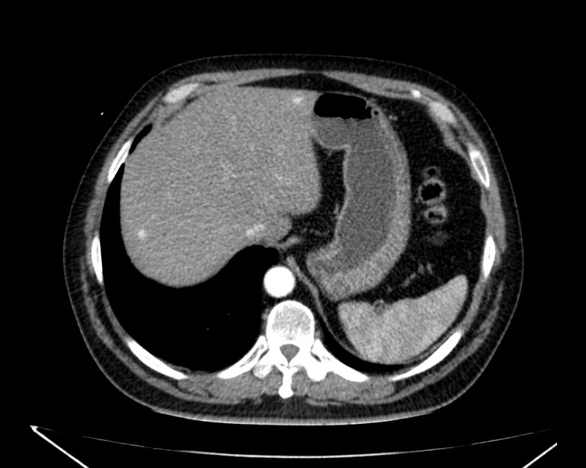 Carcinoid tumor with hepatic metastases (Radiopaedia 22651-22670 B 15).jpg
