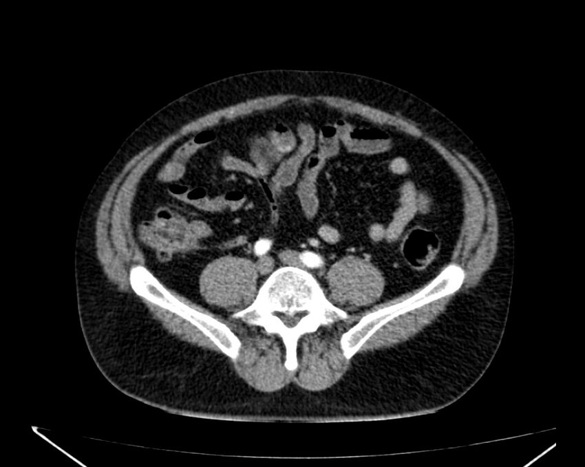 Carcinoid tumor with hepatic metastases (Radiopaedia 22651-22670 B 59).jpg