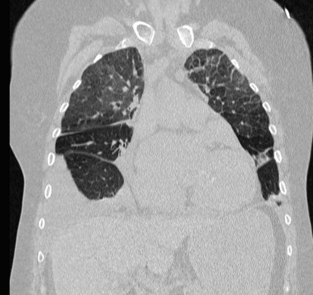 File:Cardiogenic pulmonary edema (Radiopaedia 29213-29609 Coronal lung window 25).jpg