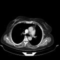 Carotid body tumor (Radiopaedia 21021-20948 A 34).jpg