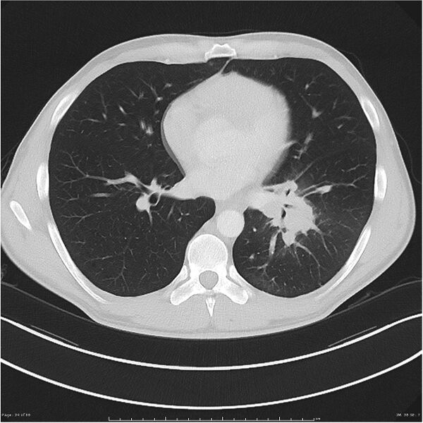 File:Cavitating lung cancer (Radiopaedia 25796-25945 Axial lung window 34).jpg