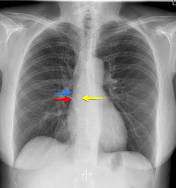 File:Cavo-atrial junction (chest x-ray) (Radiopaedia 29809).jpg