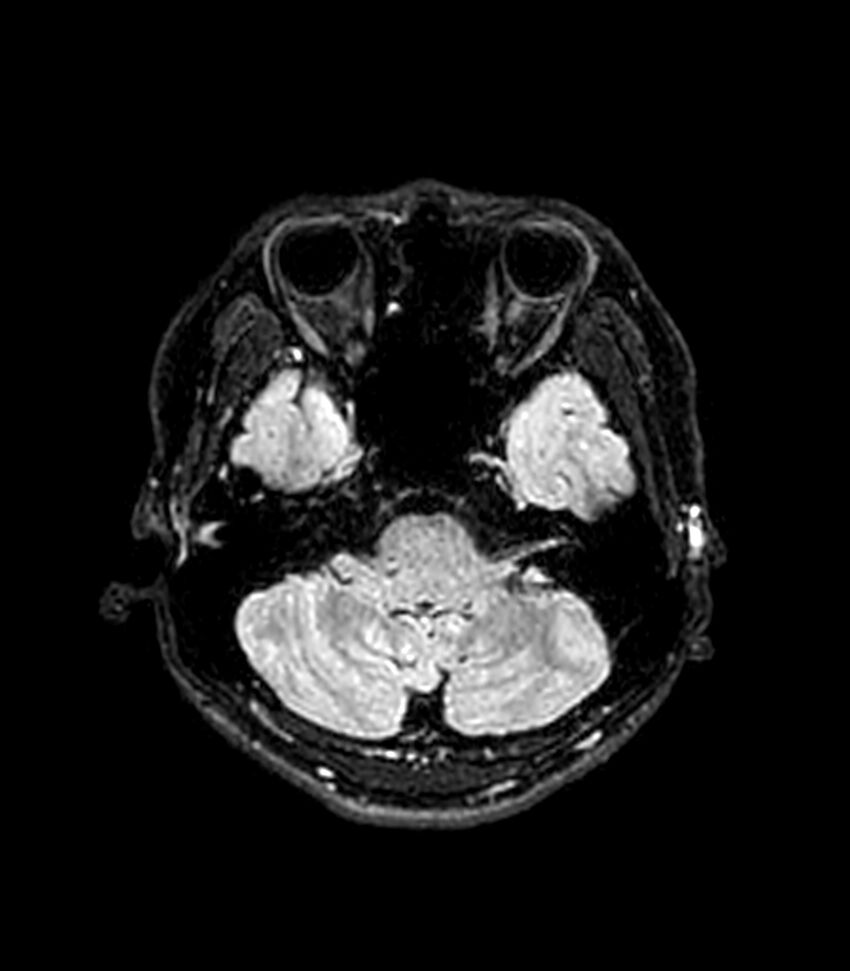 Central neurocytoma (Radiopaedia 79320-92380 Axial FLAIR 233).jpg
