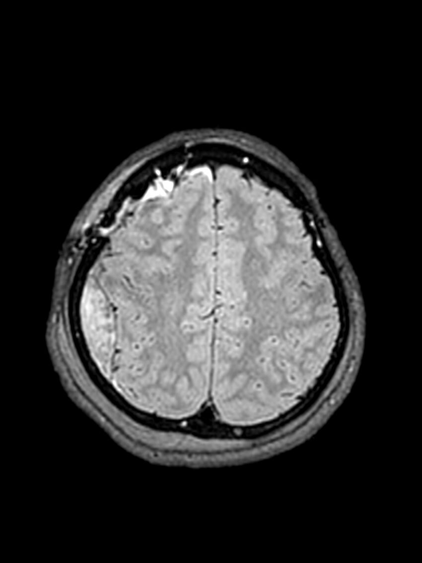 Central neurocytoma (Radiopaedia 79320-92381 Axial FLAIR 50).jpg