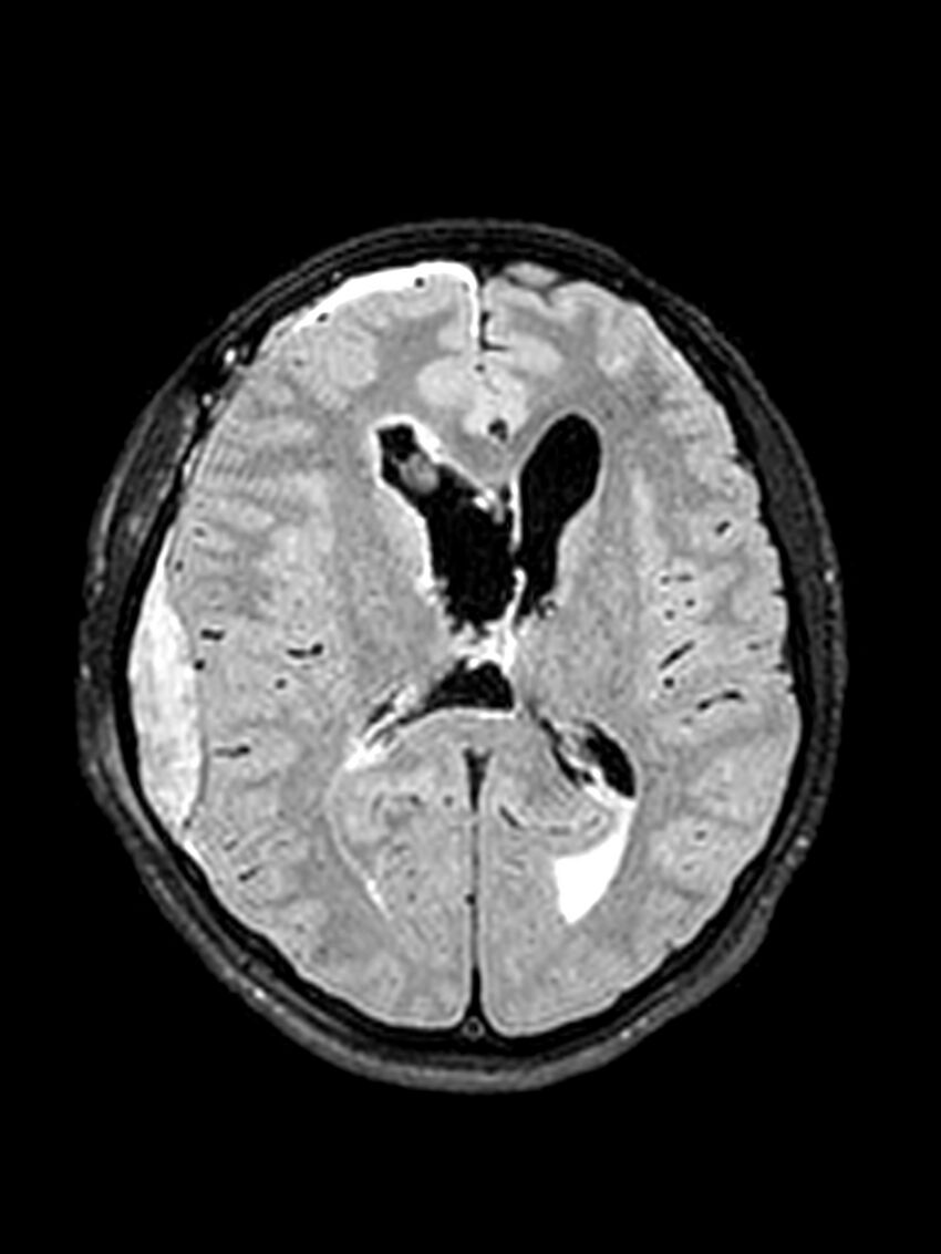 Central neurocytoma (Radiopaedia 79320-92381 Axial FLAIR 81).jpg