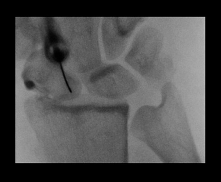 File:Central triangular fibrocartilage perforation (Radiopaedia 73346-84096 Dorsoventral 2).jpg
