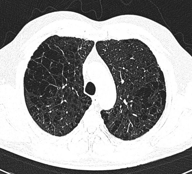 File:Centrilobular pulmonary emphysema (Radiopaedia 26808-26971 Axial lung window 11).jpg