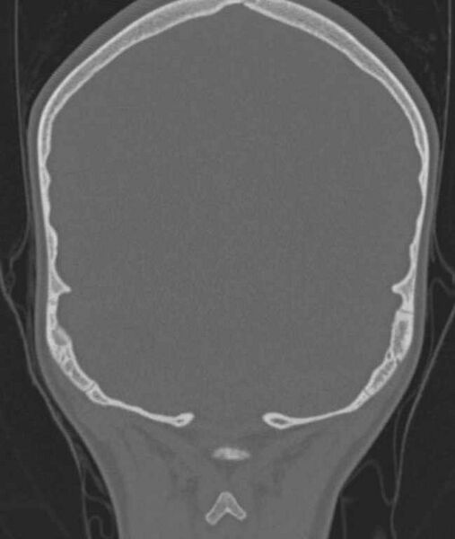 File:Cerebellar abscess (Radiopaedia 73727-84527 Coronal bone window 1).jpg