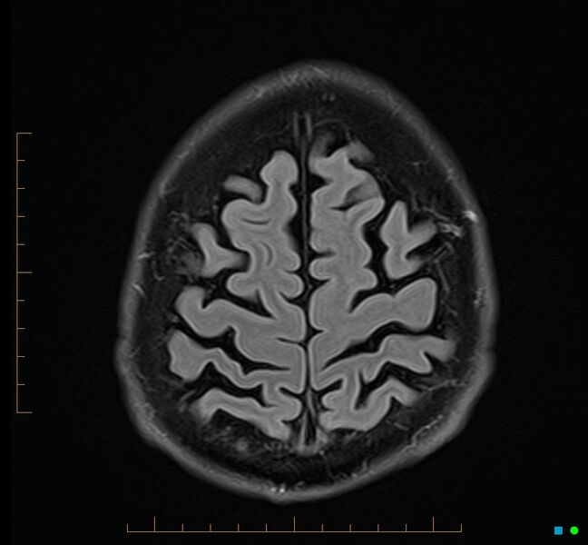 File:Cerebellar gangliocytoma (Radiopaedia 65377-74422 Axial FLAIR 34).jpg