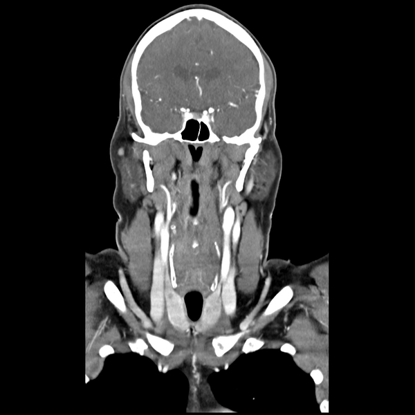 File:Cerebellar infarct due to vertebral artery dissection with posterior fossa decompression (Radiopaedia 82779-97029 D 25).png