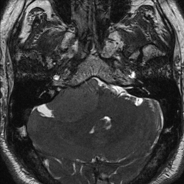 File:Cerebellopontine angle meningioma (Radiopaedia 24459-24764 I 18).jpg