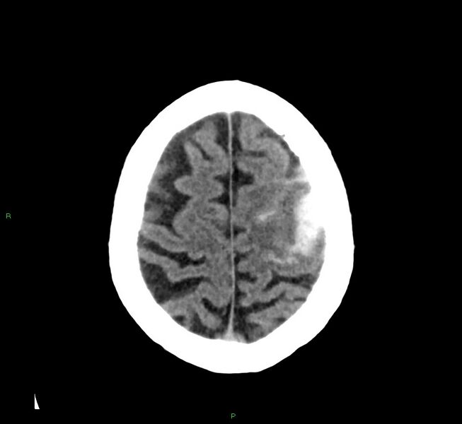 File:Cerebral amyloid angiopathy-associated lobar intracerebral hemorrhage (Radiopaedia 58376-65511 Axial non-contrast 13).jpg
