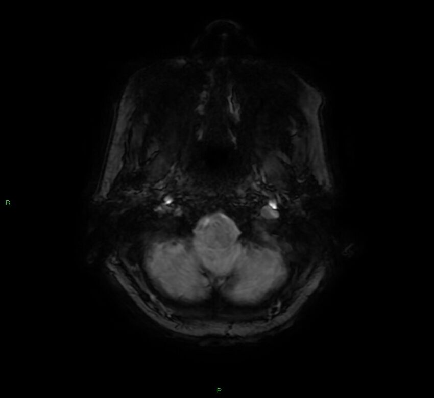 Cerebral amyloid angiopathy-associated lobar intracerebral hemorrhage (Radiopaedia 58378-65517 Axial SWI 8).jpg