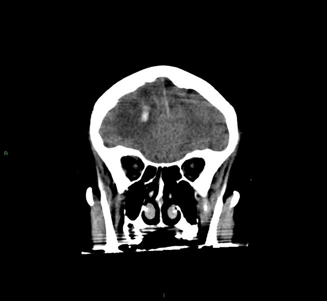 File:Cerebral amyloid angiopathy-associated lobar intracerebral hemorrhage (Radiopaedia 58560-65723 Coronal non-contrast 53).jpg