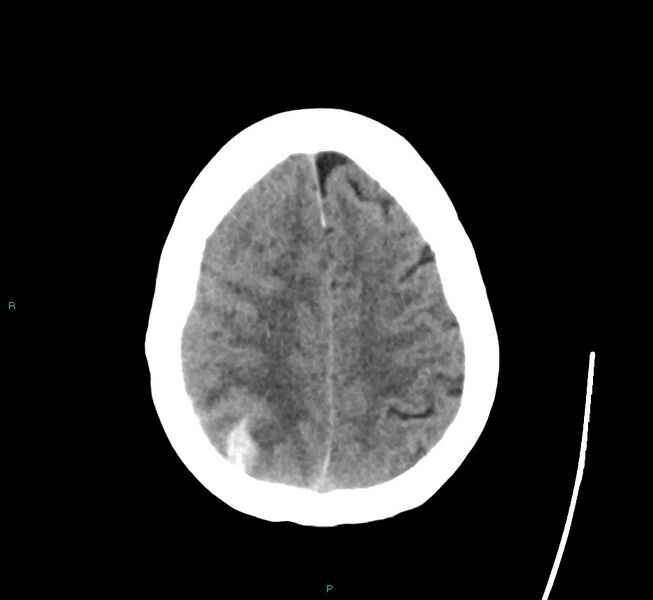 File:Cerebral amyloid angiopathy-associated lobar intracerebral hemorrhage (Radiopaedia 58563-65727 Axial non-contrast 15).jpg