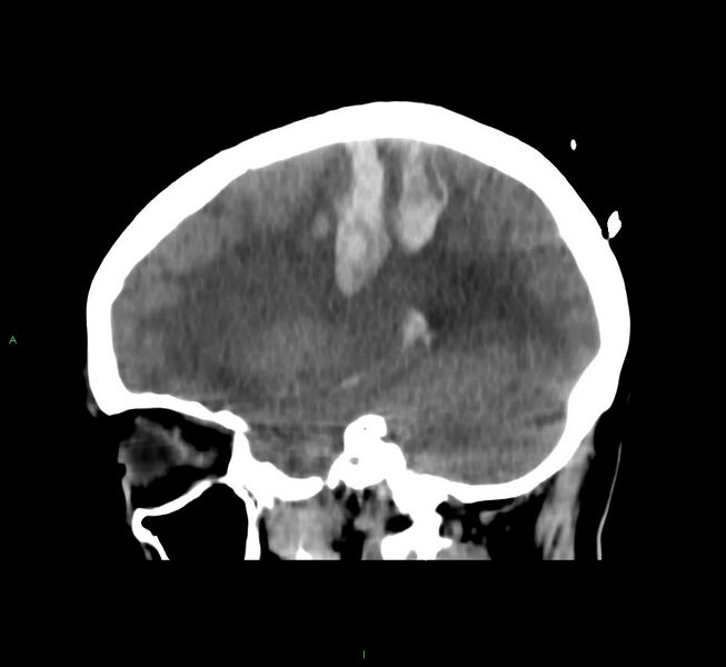 File:Cerebral amyloid angiopathy-associated lobar intracerebral hemorrhage (Radiopaedia 58566-65730 C 17).jpg