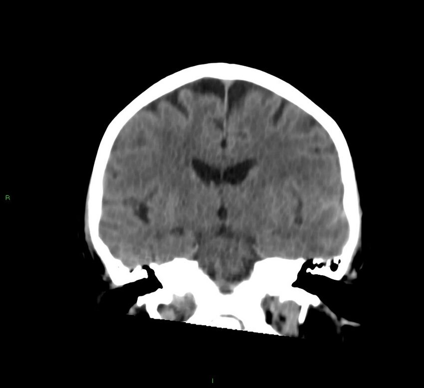 Cerebral amyloid angiopathy-associated lobar intracerebral hemorrhage (Radiopaedia 58757-65978 Coronal non-contrast 36).jpg