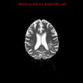 Cerebral and orbital tuberculomas (Radiopaedia 13308-13311 Axial DWI 32).jpg