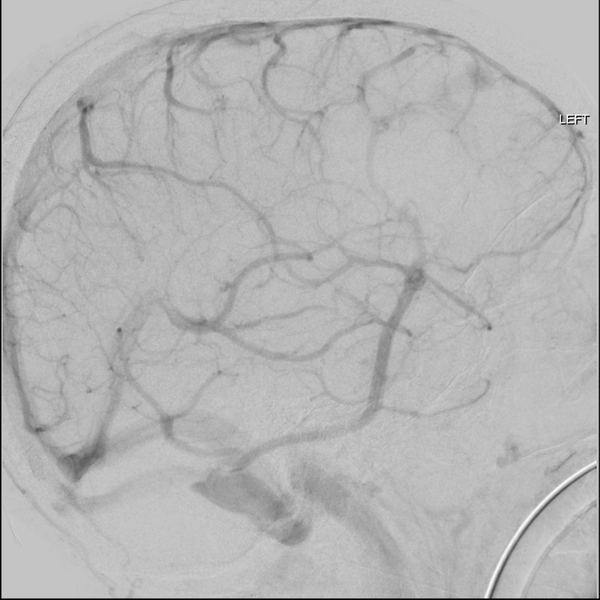 File:Cerebral arteriovenous malformation with lobar hemorrhage (Radiopaedia 44725-48513 LT CCA IC 42).png