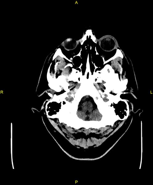 File:Cerebral autosomal dominant arteriopathy with subcortical infarcts and leukoencephalopathy (CADASIL) (Radiopaedia 86108-102051 Axial non-contrast 10).jpg
