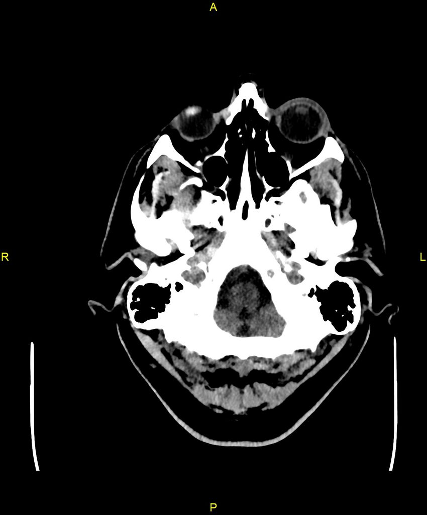Cerebral autosomal dominant arteriopathy with subcortical infarcts and leukoencephalopathy (CADASIL) (Radiopaedia 86108-102051 Axial non-contrast 10).jpg