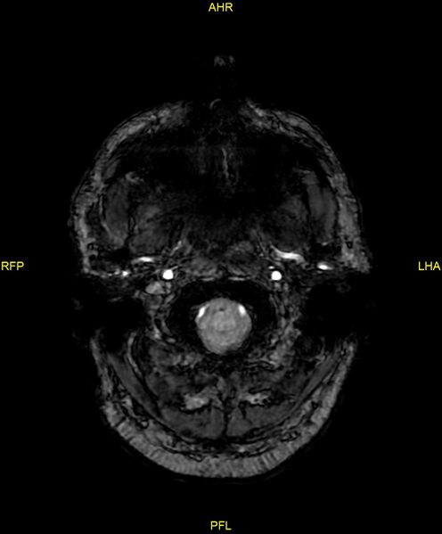 File:Cerebral autosomal dominant arteriopathy with subcortical infarcts and leukoencephalopathy (CADASIL) (Radiopaedia 86108-102054 Axial SWI 9).jpg