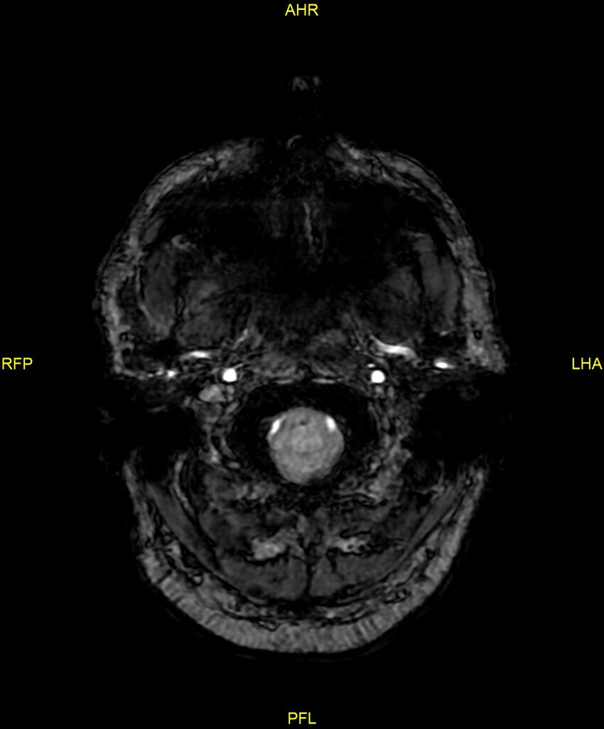 Cerebral autosomal dominant arteriopathy with subcortical infarcts and leukoencephalopathy (CADASIL) (Radiopaedia 86108-102054 Axial SWI 9).jpg