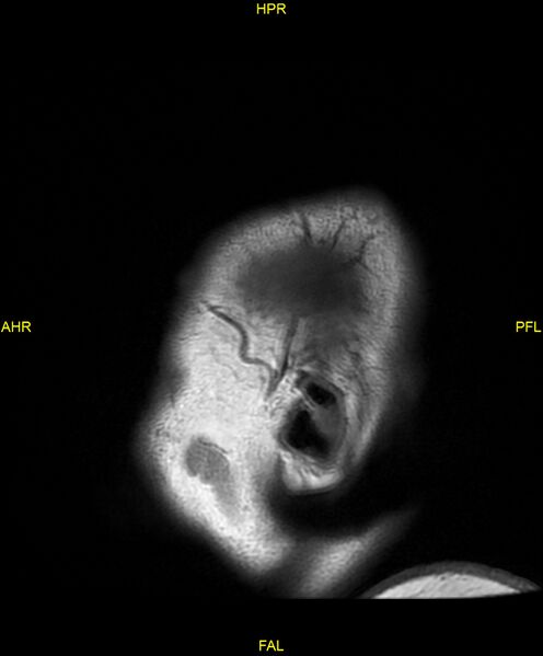File:Cerebral autosomal dominant arteriopathy with subcortical infarcts and leukoencephalopathy (CADASIL) (Radiopaedia 86108-102054 Sagittal T1 1).jpg