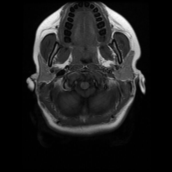 File:Cerebral cavernous malformation (Radiopaedia 44301-47942 Axial T1 2).jpg