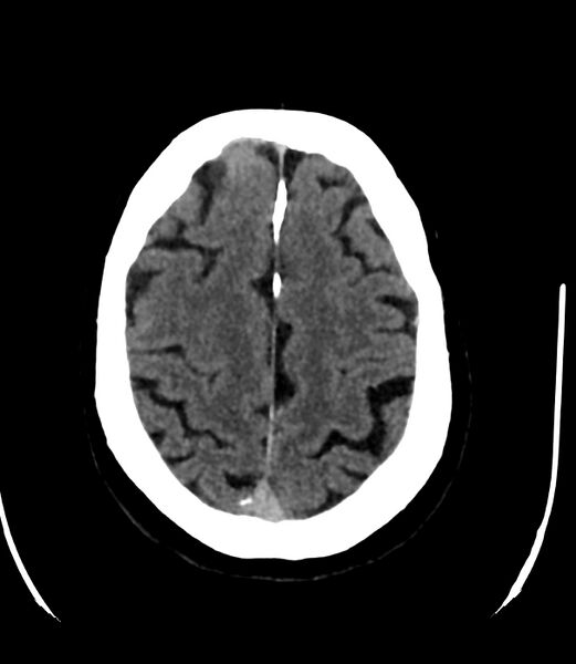 File:Cerebral dural venous sinus thrombosis (Radiopaedia 86514-102575 Axial non-contrast 34).jpg