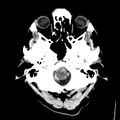 Cerebral hemorrhagic contusions (Radiopaedia 23145-23188 Axial non-contrast 3).jpg